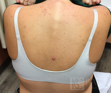 Acne Treatment Before - Paramus, NJ Acne Treatment Before - Paramus, NJ