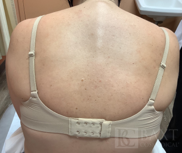 Acne Treatment After - Paramus, NJ Acne Treatment After - Paramus, NJ