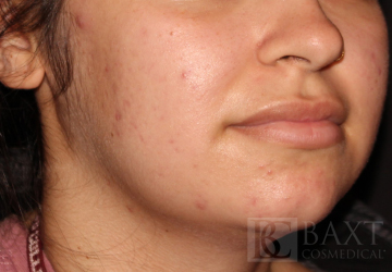 Acne Treatment After - Paramus, NJ Acne Treatment After - Paramus, NJ