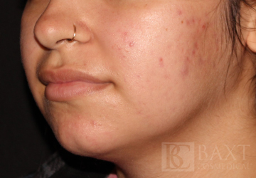 Acne Treatment After - Paramus, NJ Acne Treatment After - Paramus, NJ