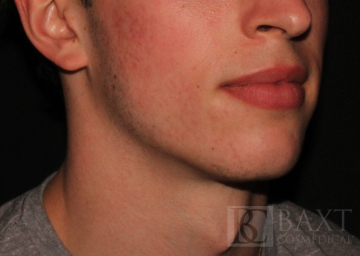 Acne Treatment After - Paramus, NJ Acne Treatment After - Paramus, NJ