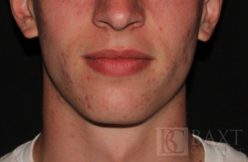 Acne Treatment Before - Paramus, NJ Acne Treatment Before - Paramus, NJ