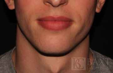 Acne Treatment After - Paramus, NJ Acne Treatment After - Paramus, NJ