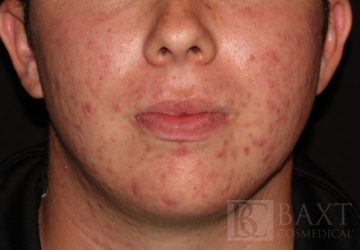 Acne Treatment Before - Paramus, NJ