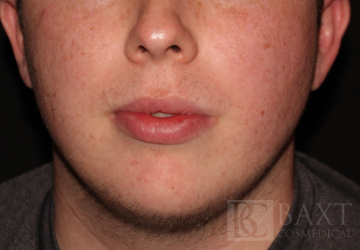 Acne Treatment After - Paramus, NJ
