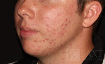 Acne Treatment Before - Paramus, NJ