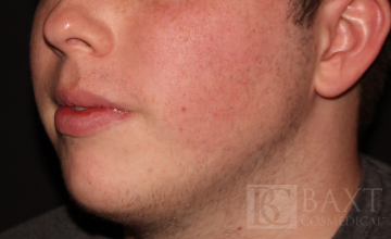 Acne Treatment After - Paramus, NJ