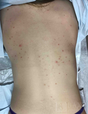 Acne Treatment Before - Paramus, NJ