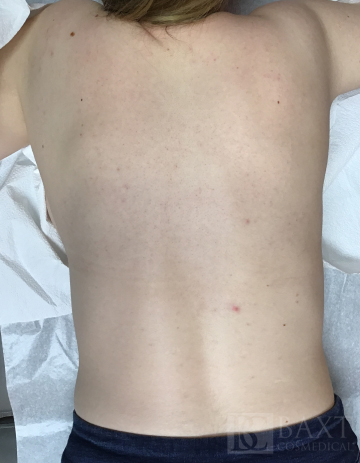 Acne Treatment After - Paramus, NJ