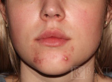 Acne Treatment Before - Paramus, NJ