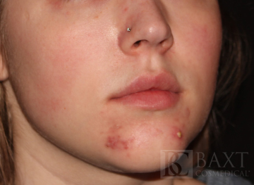 Acne Treatment Before - Paramus, NJ