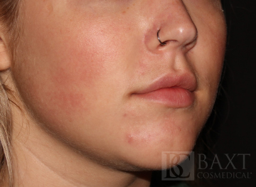 Acne Treatment After - Paramus, NJ