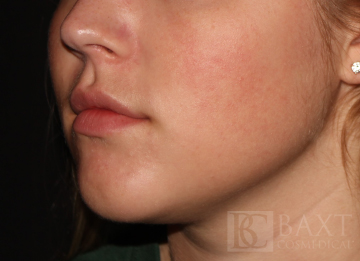 Acne Treatment After - Paramus, NJ
