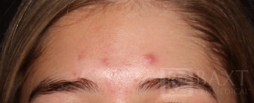 Acne Treatment Before - Paramus, NJ