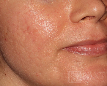 Acne Treatment Before - Paramus, NJ