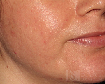 Acne Treatment After - Paramus, NJ