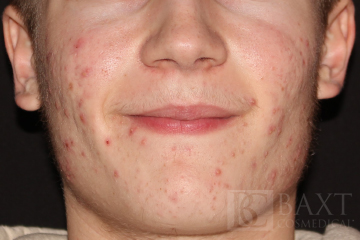 Acne Treatment Before - Paramus, NJ