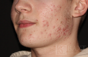 Acne Treatment Before - Paramus, NJ