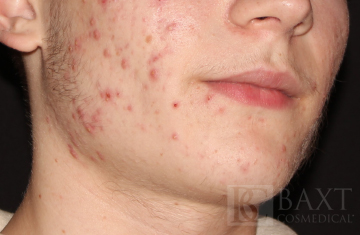 Acne Treatment Before - Paramus, NJ