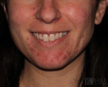 Acne Treatment Before - Paramus, NJ