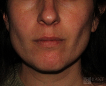 Acne Treatment After - Paramus, NJ