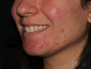 Acne Treatment Before - Paramus, NJ