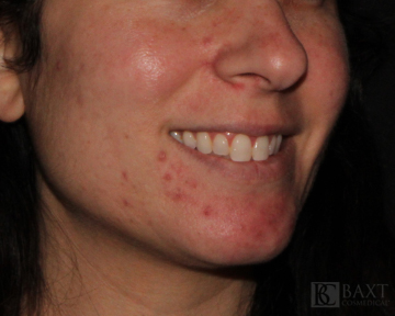 Acne Treatment Before - Paramus, NJ