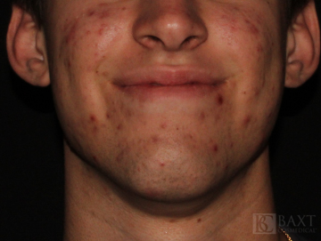 Acne Treatment Before - Paramus, NJ