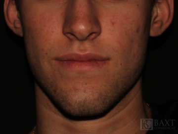 Acne Treatment After - Paramus, NJ
