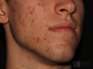 Acne Treatment Before - Paramus, NJ