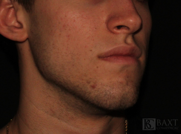 Acne Treatment After - Paramus, NJ
