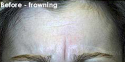 BOTOX® Cosmetic Before - Paramus, NJ BOTOX® Cosmetic Before - Paramus, NJ