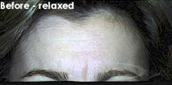 BOTOX® Cosmetic Before - Paramus, NJ BOTOX® Cosmetic Before - Paramus, NJ