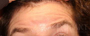 BOTOX® Cosmetic Before - Paramus, NJ BOTOX® Cosmetic Before - Paramus, NJ