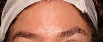 BOTOX® Cosmetic After - Paramus, NJ BOTOX® Cosmetic After - Paramus, NJ
