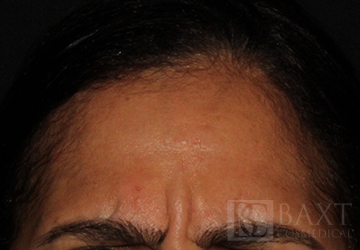 BOTOX® Cosmetic Before - Paramus, NJ BOTOX® Cosmetic Before - Paramus, NJ