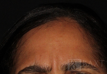 BOTOX® Cosmetic After - Paramus, NJ BOTOX® Cosmetic After - Paramus, NJ