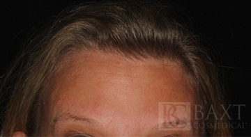 BOTOX® Cosmetic After - Paramus, NJ BOTOX® Cosmetic After - Paramus, NJ
