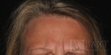 BOTOX® Cosmetic Before - Paramus, NJ BOTOX® Cosmetic Before - Paramus, NJ