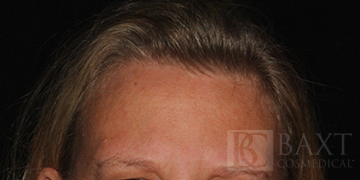 BOTOX® Cosmetic After - Paramus, NJ BOTOX® Cosmetic After - Paramus, NJ