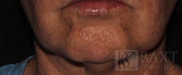 BOTOX® Cosmetic Before - Paramus, NJ BOTOX® Cosmetic Before - Paramus, NJ