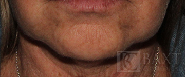 BOTOX® Cosmetic After - Paramus, NJ BOTOX® Cosmetic After - Paramus, NJ