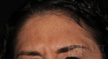 BOTOX® Cosmetic Before - Paramus, NJ BOTOX® Cosmetic Before - Paramus, NJ