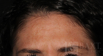 BOTOX® Cosmetic After - Paramus, NJ BOTOX® Cosmetic After - Paramus, NJ