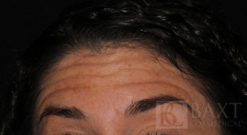BOTOX® Cosmetic Before - Paramus, NJ BOTOX® Cosmetic Before - Paramus, NJ