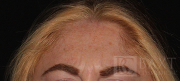 BOTOX® Cosmetic Before - Paramus, NJ BOTOX® Cosmetic Before - Paramus, NJ