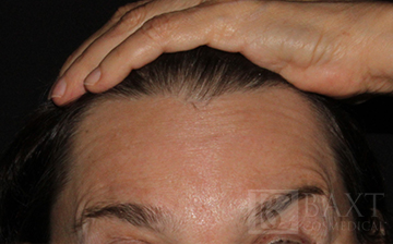 BOTOX® Cosmetic After - Paramus, NJ BOTOX® Cosmetic After - Paramus, NJ
