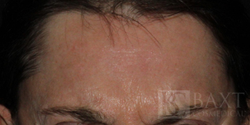 BOTOX® Cosmetic Before - Paramus, NJ BOTOX® Cosmetic Before - Paramus, NJ