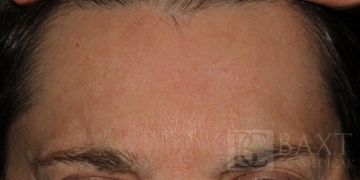 BOTOX® Cosmetic After - Paramus, NJ BOTOX® Cosmetic After - Paramus, NJ