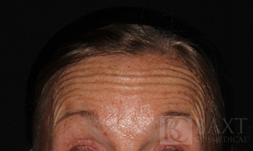 BOTOX® Cosmetic Before - Paramus, NJ